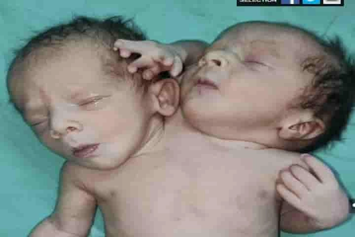 Baby with a rare condition of two heads, three arms and two hearts born in Madhya Pradesh