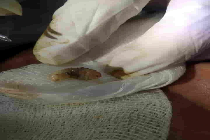 Delhi hospital removes 3 live human botflies from an American woman