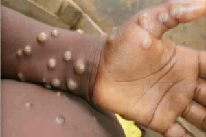 Delhi reports first case of monkeypox in man with no history of foreign travel