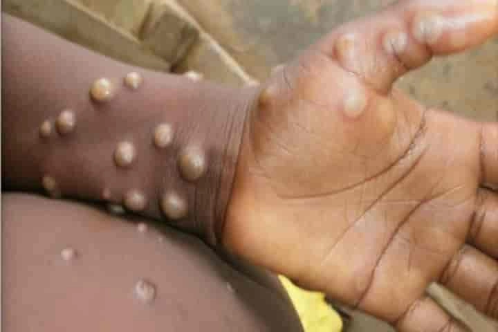 India’s first case of monkeypox confirmed in Kerala, Centre rushes team to help state