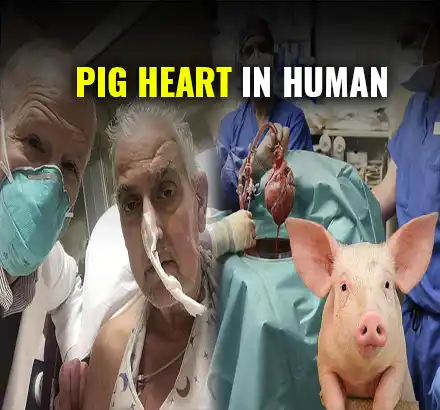 US Surgeons Transplant Pig’s Heart In A Human, Patient Recovering Well & Under Observation