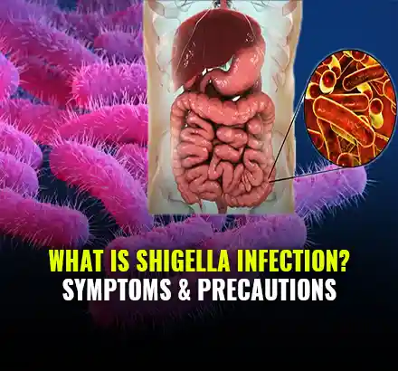 Shawarma Food Poisoning Case: What Are Shigella Bacteria, Shigella Infection Symptoms & Precautions?
