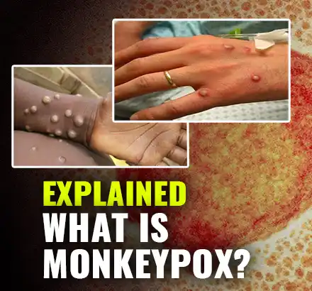 What Is Monkeypox? Symptoms Of Monkeypox Virus Infection- UK Reports A Confirmed Case