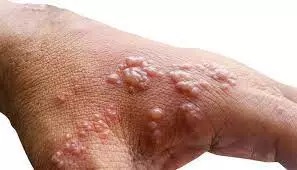 Kerala reports third case of Monkeypox in India