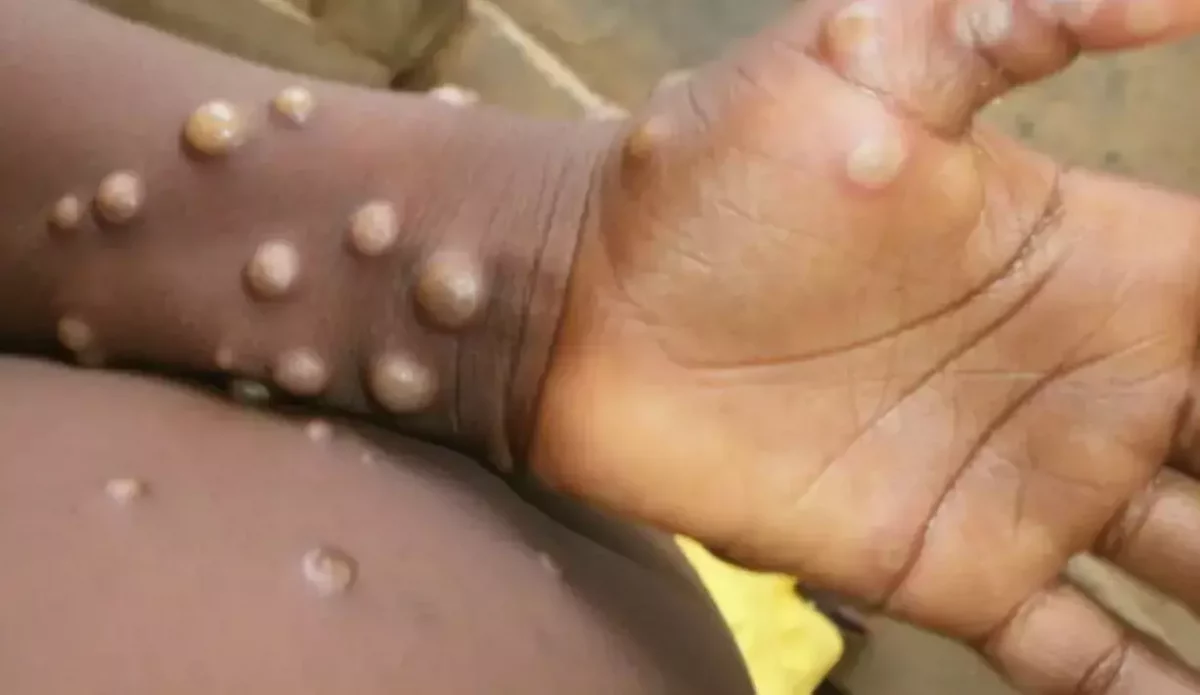 After Europe, Monkeypox spreads to USA & Canada triggering fear of global spread