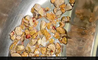 Hyderabad doctors remove 206 kidney stones from a 56-year-old man in keyhole surgery.