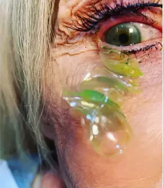 WATCH: Doctor removes 23 contact lenses stuck in woman’s eye